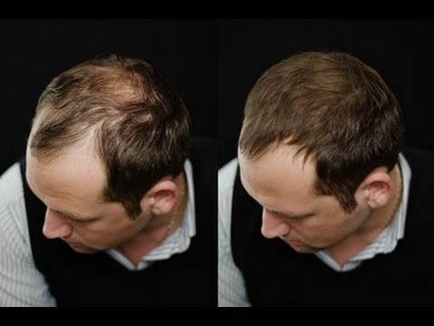 how to regrow hair on top of head